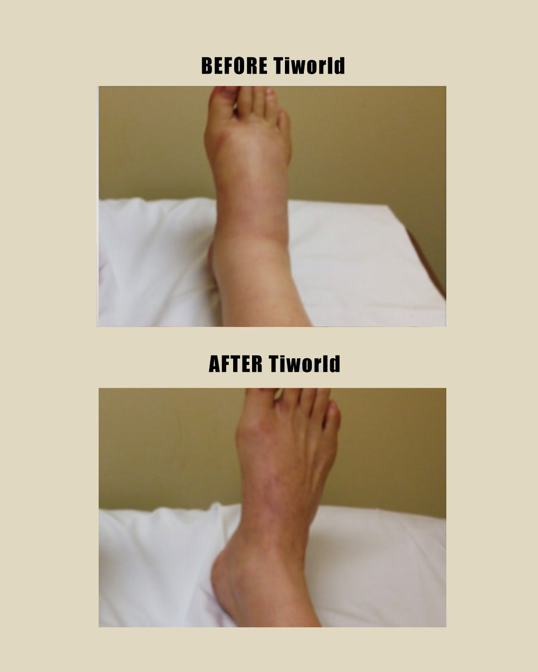 Tiworld Bee Venom & Turmeric Arthritis Therapy Cream