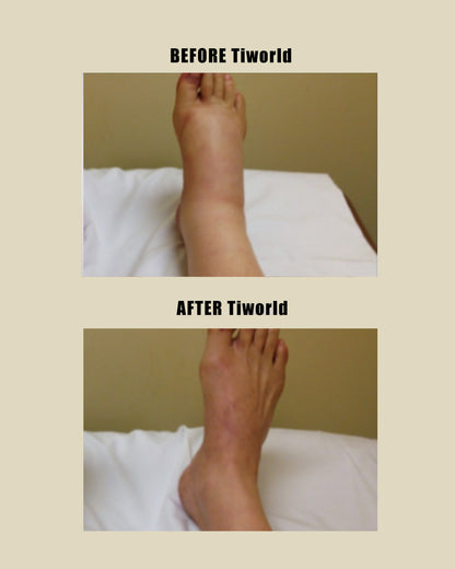 Tiworld Bee Venom & Turmeric Arthritis Therapy Cream