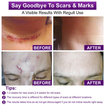 SEAGRIL™ Scar Gel –  Clinically Proven Formula to Soften, Flatten & Fade Scars from Surgery, Acne, Burns, and Keloids